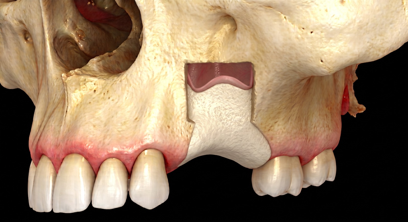 Step 3: the bone graft material consolidated into solid bone after the maturation period